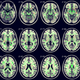 Illustration for article titled Brain Abnormalities Linked To Chronic Fatigue